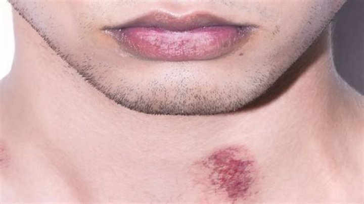 Are Hickeys Permanent? Unveiling the Truth About Love Bites