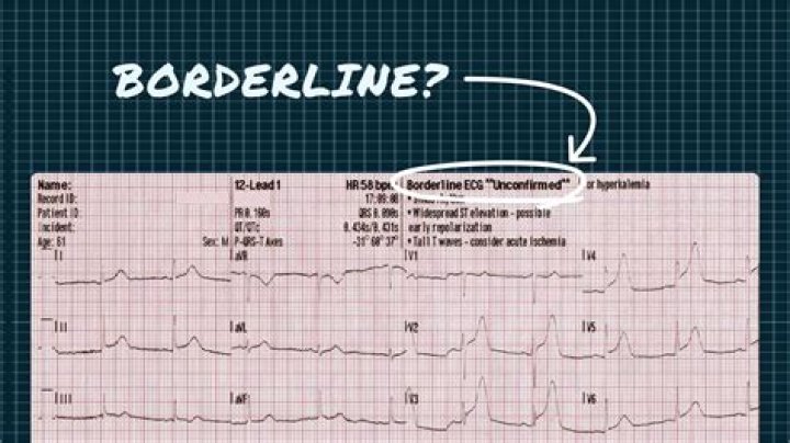 Understanding Borderline ECG: A Comprehensive Guide for Better Heart Health