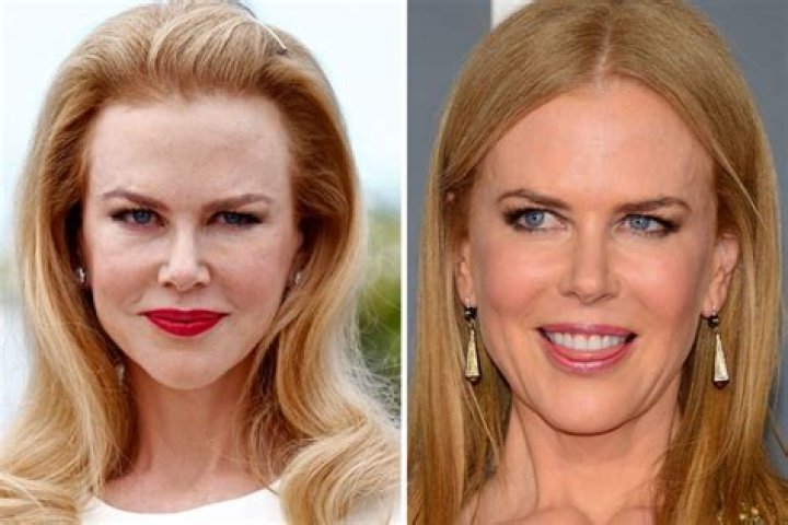 Nicole Kidman Botox: Exploring the Truth Behind Her Ageless Beauty