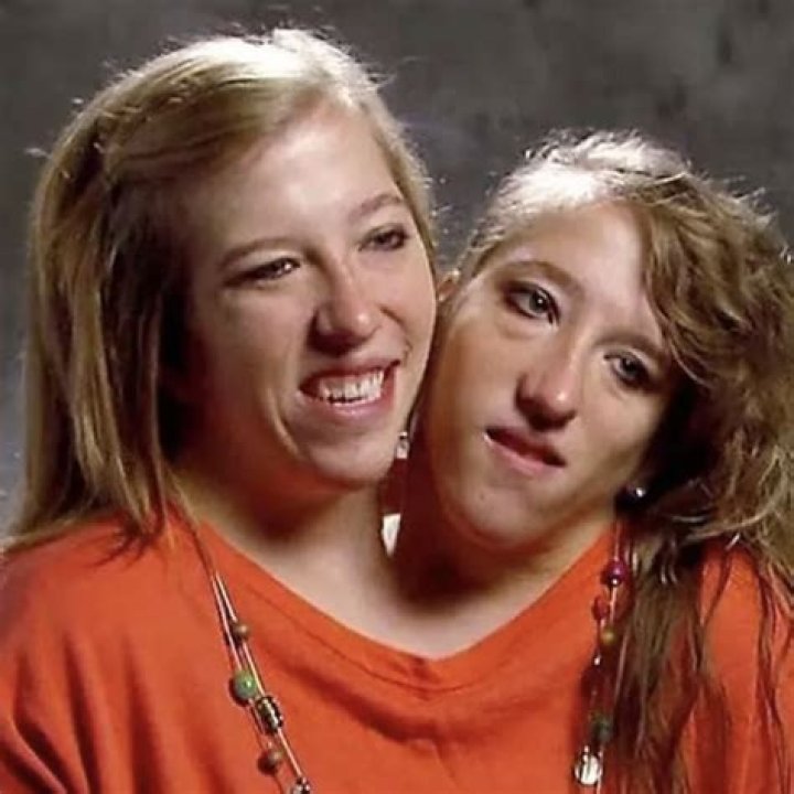 Brittany Conjoined Twins: A Journey of Resilience and Medical Marvel