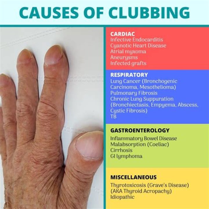 Understanding Clubitis Disease: Symptoms, Causes, Diagnosis, and Treatment