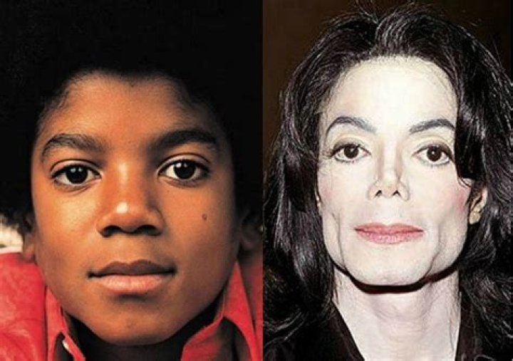 Did Michael Jackson Have Vitiligo Disease? Unveiling the Truth Behind the King of Pop's Skin Condition