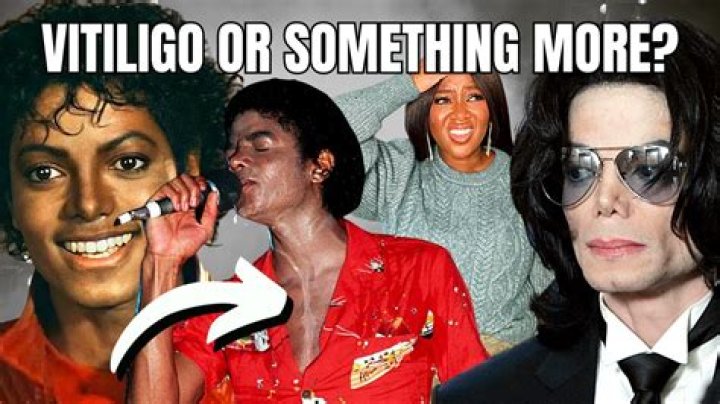 Did MJ Have Vitiligo? Unveiling the Truth Behind Michael Jackson's Skin Condition