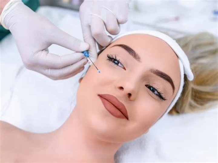 Dimple Filler: The Ultimate Guide to Achieving Natural Cheek Dimples