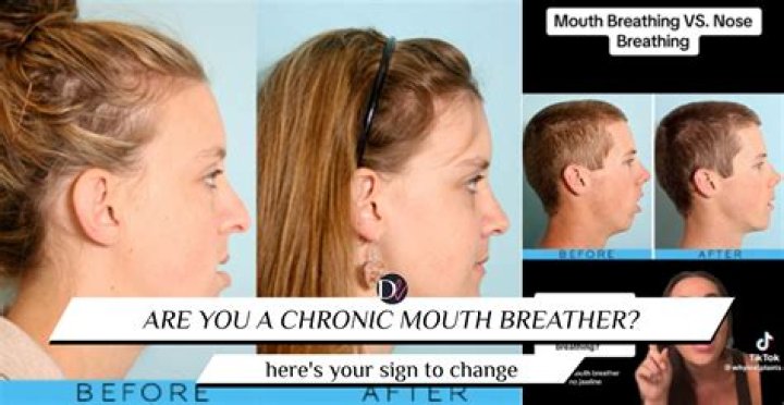 Does Mouth Breathing Affect Your Jawline? Understanding the Science Behind It