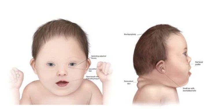 Does Simon Cowell's Son Have Down Syndrome? Unveiling the Truth