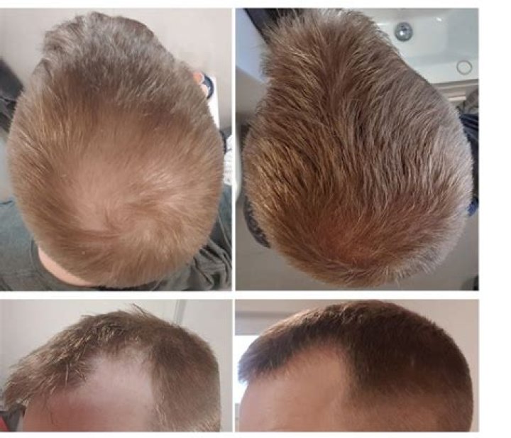 Does Bumptopper Cause Hair Loss? Unveiling the Truth