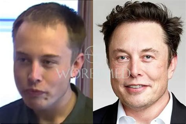 Elon Musk Nose Job: The Truth Behind the Rumors