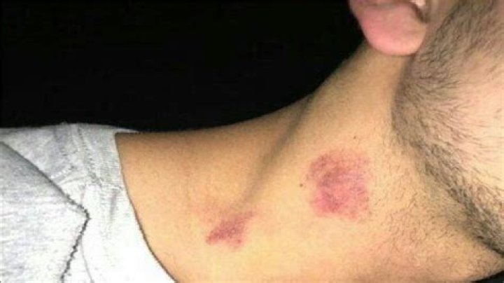 How to Give Yourself a Hickey on the Neck: A Comprehensive Guide