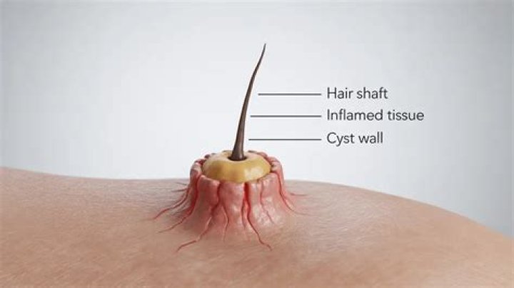 How to Heal Ingrown Hair Cyst: A Comprehensive Guide