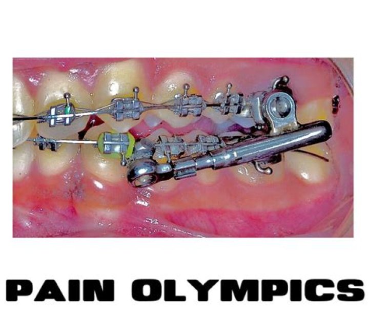 Is the BME Pain Olympics Real? Exploring the Controversial World of Extreme Body Modification