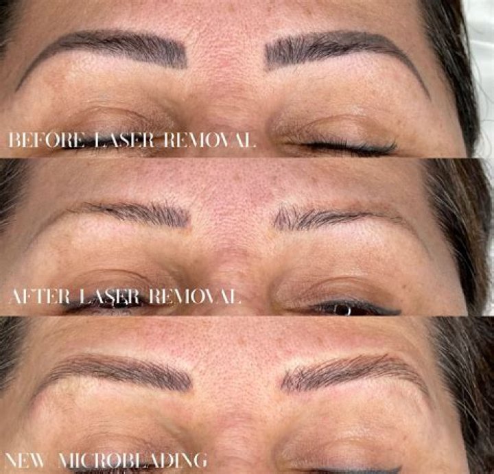 Laser Eyebrow Tattoo Removal Cost: A Comprehensive Guide to Understanding the Procedure