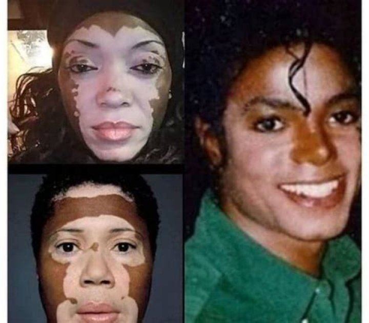 Michael Jackson Whitening: The Truth Behind the Legend&rsquo;s Skin Transformation