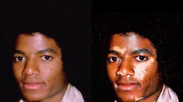 Michael Jackson with Vitiligo: A Comprehensive Look into the King of Pop's Journey