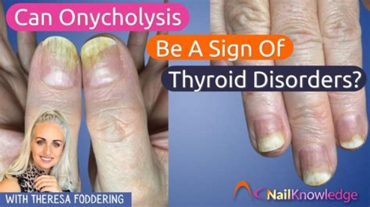 Nail Ridges and Thyroid Problems: What You Need to Know