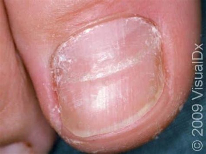 Understanding Horizontal Nail Lines: Causes, Symptoms, and Treatment
