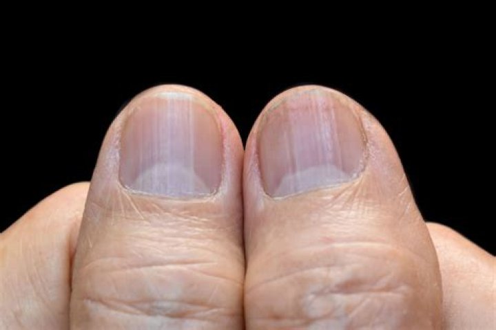 Nail Ridges Causes: Understanding the Science Behind Nail Ridges