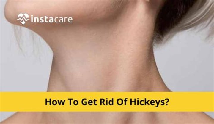 Understanding Neck Hickeys: Causes, Effects, and Treatment Options