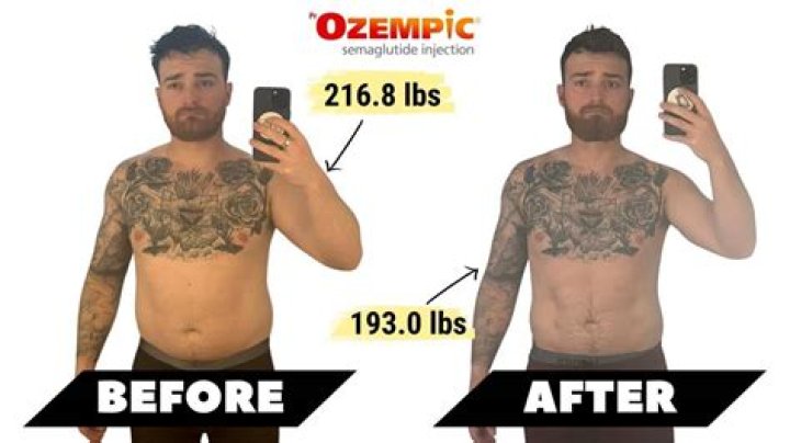 Ozempic Before and After: Transforming Lives Through Diabetes Management