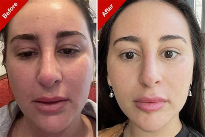 Ozempic Face Before and After: Understanding the Transformation