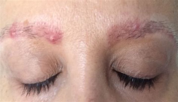 Pimple in Eyebrows: Causes, Treatments, and Prevention Tips