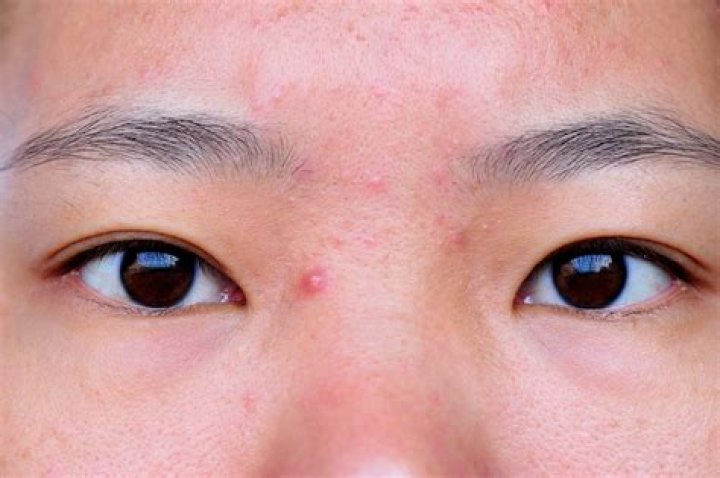Pimple on Eyebrow Hurts: Causes, Treatments, and Prevention