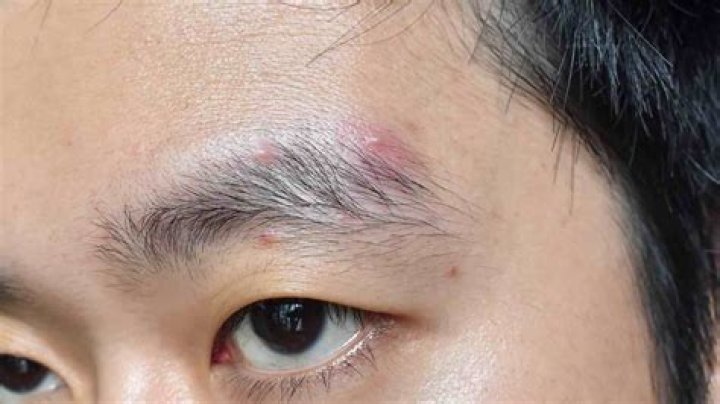 Pimple on Eyebrow: Causes, Treatments, and Prevention