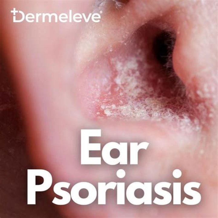 Understanding Psoriasis in Ears Pictures: A Comprehensive Guide