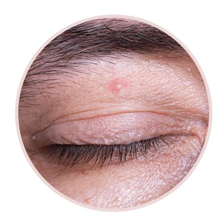 Understanding Red Bumps by the Eye: Causes, Treatments, and Prevention