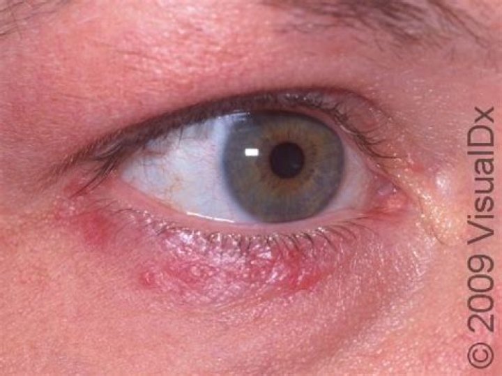 Red Bumps Under Eyes: Causes, Treatments, and Prevention