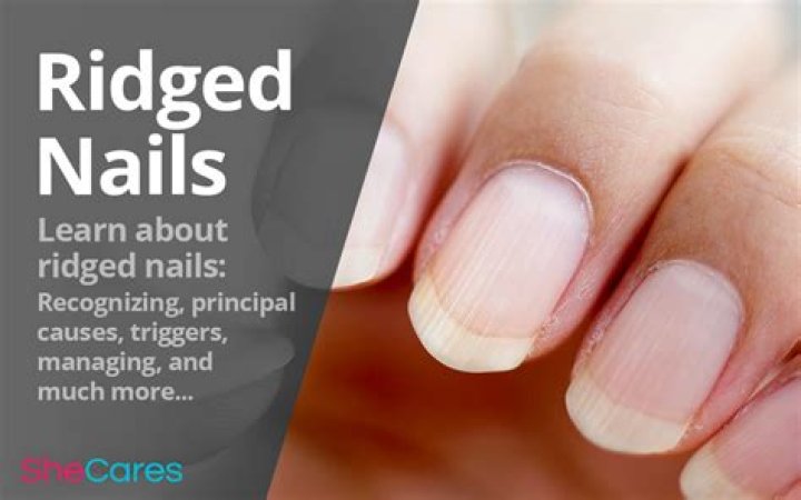 Ridges in Your Nails: What Does It Mean and How to Address It