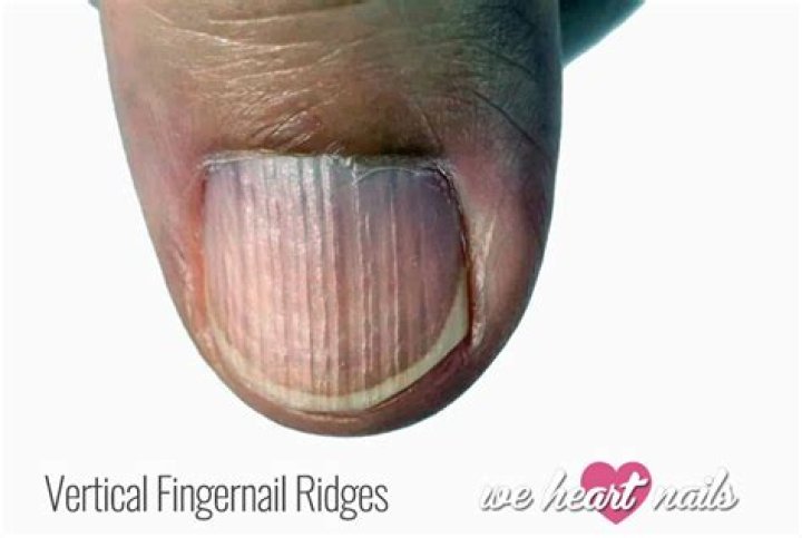 Ridges on Fingernails Means: A Comprehensive Guide to Understanding Nail Health