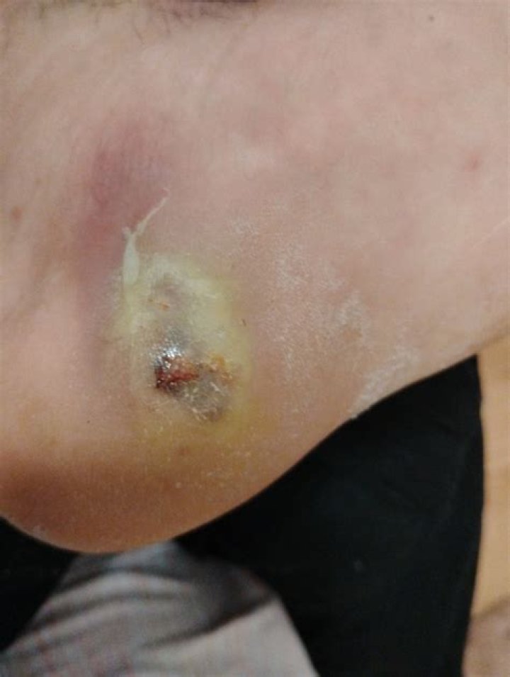 Should Cold Sores Blister Be Popped? A Comprehensive Guide