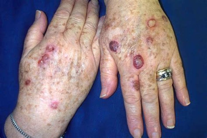 Should I Pop a Cold Sore? Comprehensive Guide to Managing Cold Sores Effectively