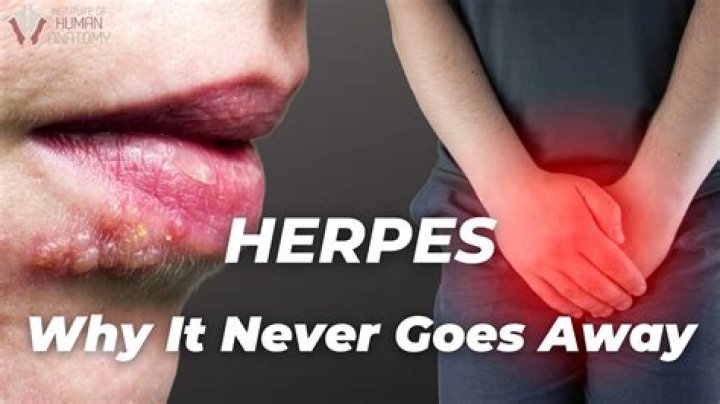 Should I Pop My Herpes? A Comprehensive Guide to Managing Herpes Symptoms