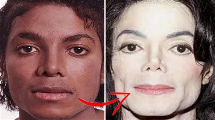 Michael Jackson's Skin Condition: The Truth Behind His Transformation
