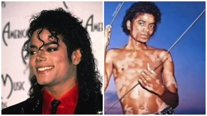 Michael Jackson's Skin Disorder: Unveiling the Truth Behind His Transformation