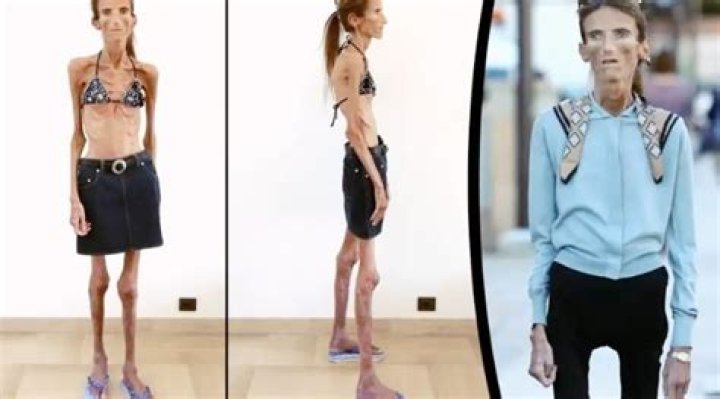 The Skinniest Person in the World: A Journey into Extreme Thinness