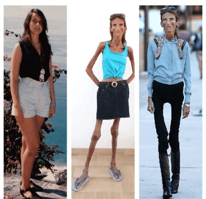 The Incredible Story of the Skinniest Woman: A Journey of Strength and Resilience