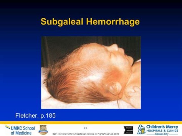 Understanding Subgaleal Hemorrhage: Causes, Symptoms, Diagnosis, and Treatment
