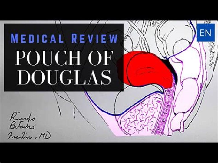 The Douglas Pouch: A Comprehensive Guide to Understanding Its Importance in Female Anatomy
