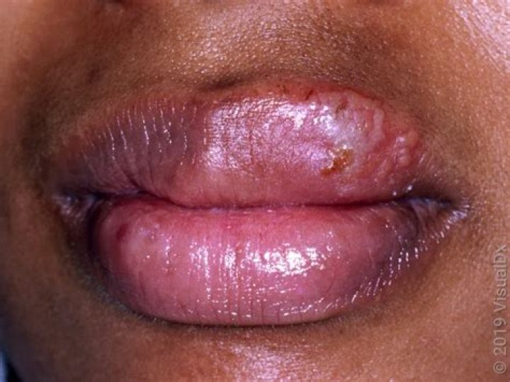 Treat Unburn Lip Blisters: A Comprehensive Guide to Healing and Prevention
