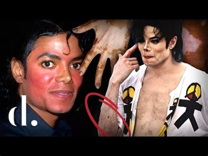 Michael Jackson's Vitiligo: Unveiling the Truth About His Skin Condition