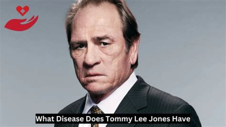 What Disease Does Tommy Lee Jones Have? A Comprehensive Look