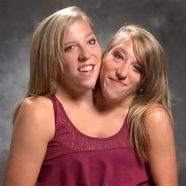 What Happened to Abby and Brittany the Conjoined Twins: A Remarkable Journey