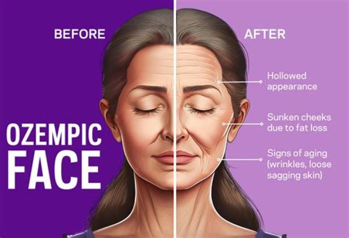 What is Ozempic Face Before and After: A Comprehensive Guide