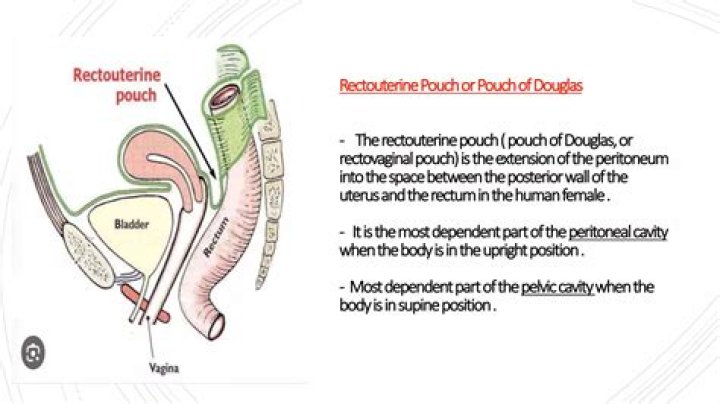 What is Pouch of Douglas: A Comprehensive Guide to Understanding its Anatomy and Importance