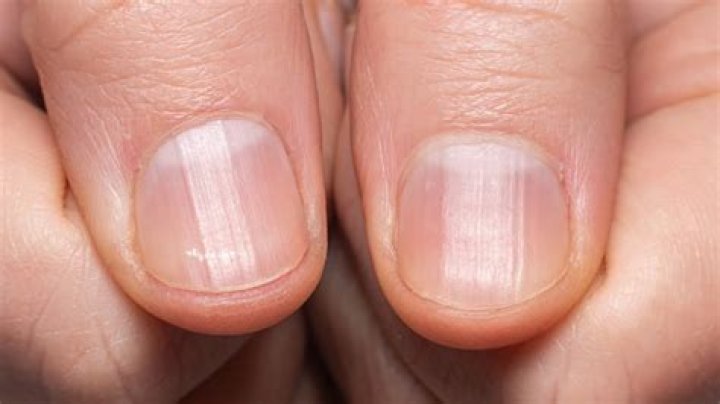 Why Are My Fingernails Ridged? Causes, Treatments, and Prevention